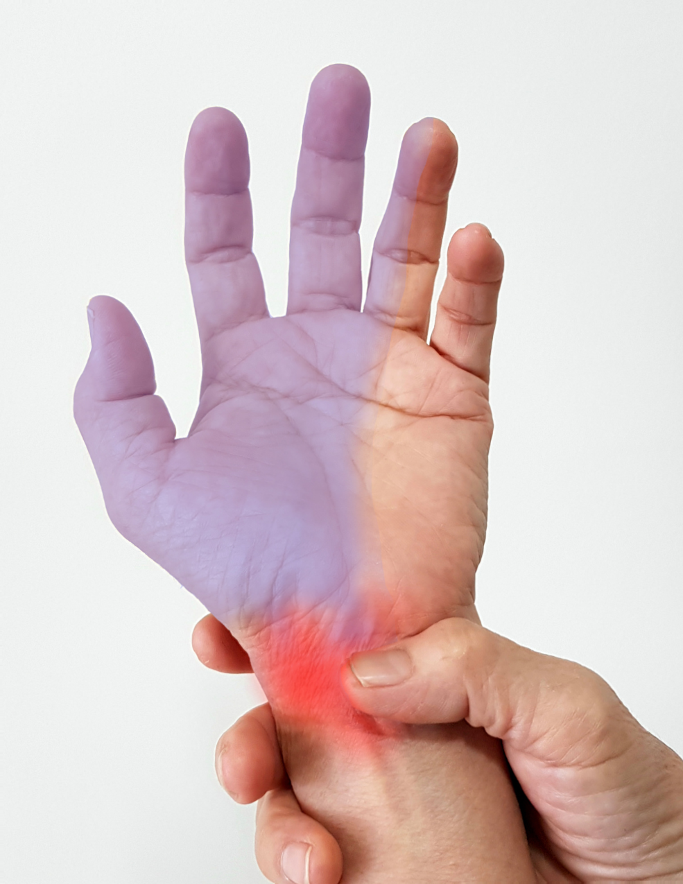 carpal tunnel syndrome