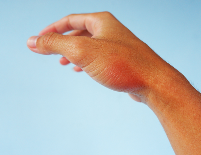 arthritis of the thumb