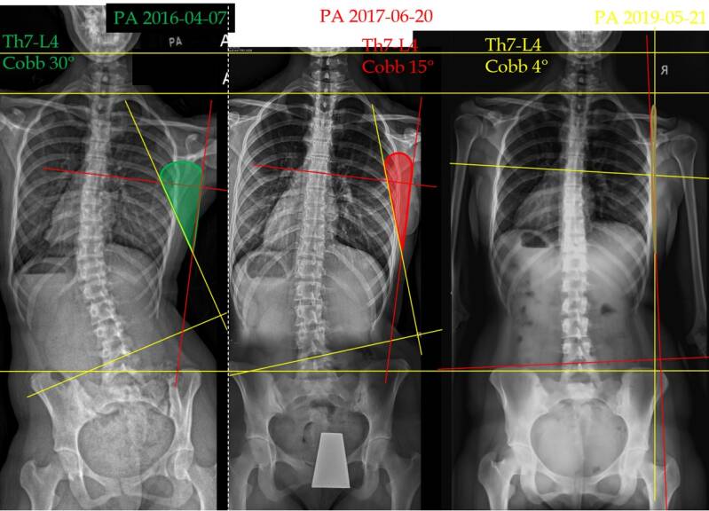 Xray of torzo 3 years apart effect of spiral satbilisation