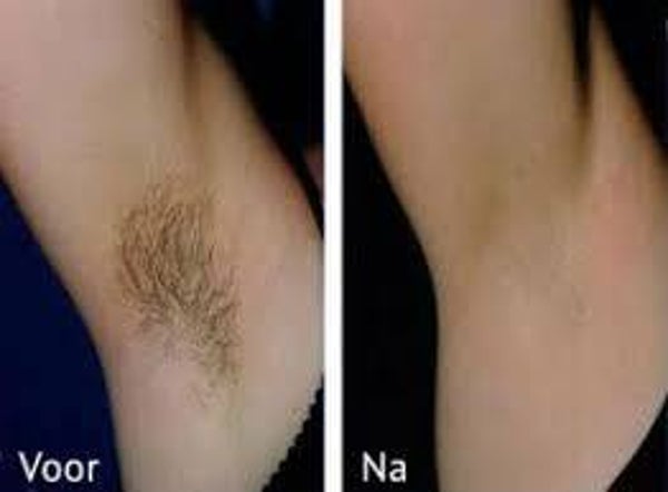 1 x laser ontharing gezicht/baard of oksels of bikinilijn