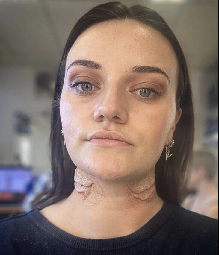 3D Transfer Prosthetics Selfmade #sfx #sfxmakeup #sfxmua #sfxartist #sfxmakeupartist #sfxwound #3dtransferprosthetics #prostheticmakeup #prosthetics #prosthetic #makeup #makeupartist #lisaschekkerman #sfxbylisaschekkerman #specialmakeupbylisaschekkerman L