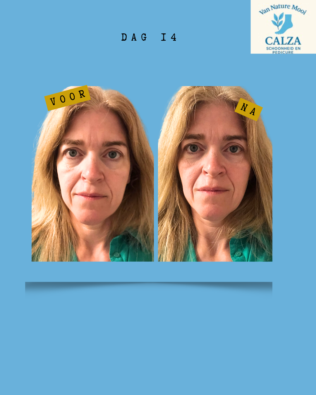 kopie-van-gray-minimalist-before-and-after-skincare-instagram-story-instagram-bericht-45-1-standard-siovxp.png