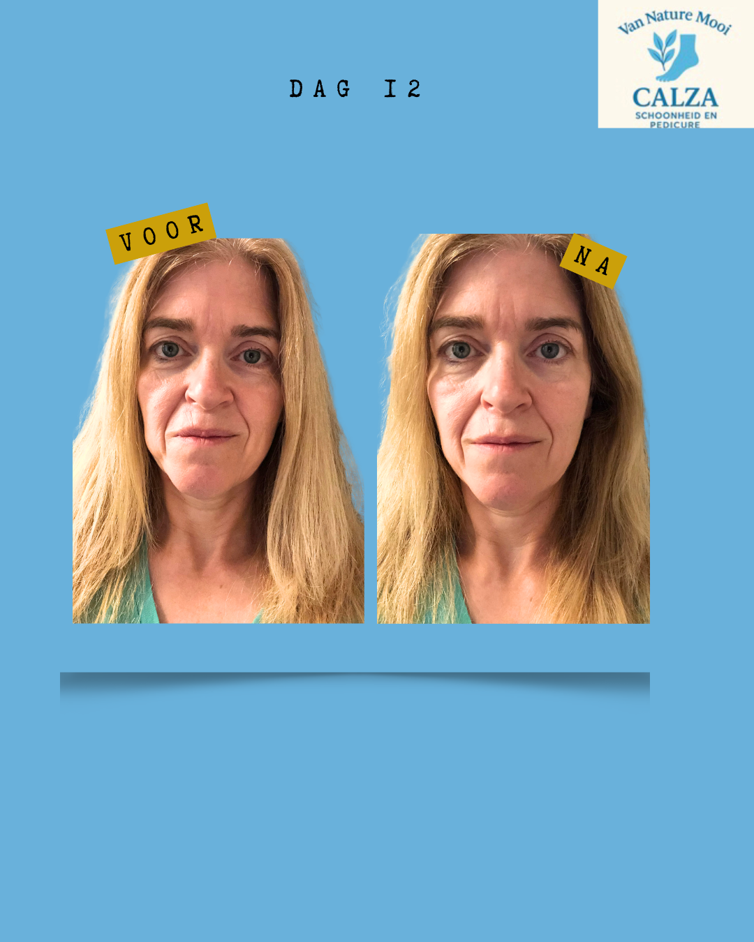 kopie-van-gray-minimalist-before-and-after-skincare-instagram-story-instagram-bericht-45-1-standard.png