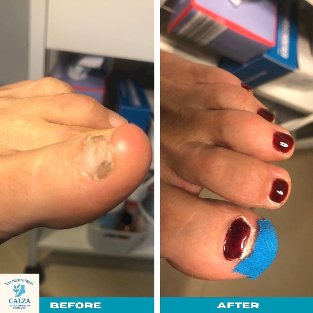 kopie-van-kopie-van-kopie-van-gray-minimalist-before-and-after-skincare-instagram-story-instagrambericht-standard.png
