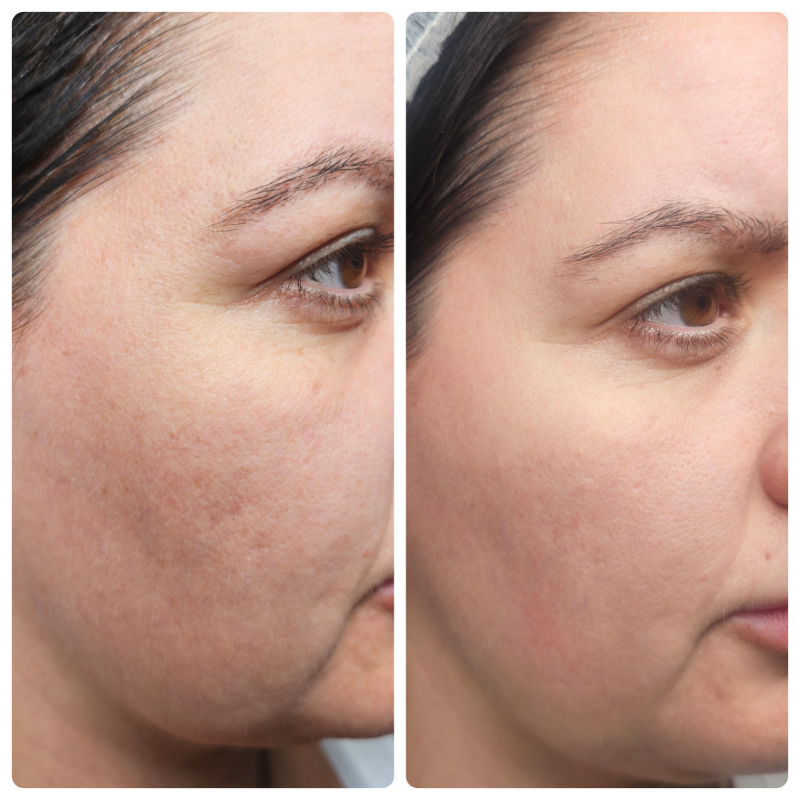 skinpen microneedling skin rejuvenatiing facial resurfacing treatments smooth texture skincare facial clondalkin