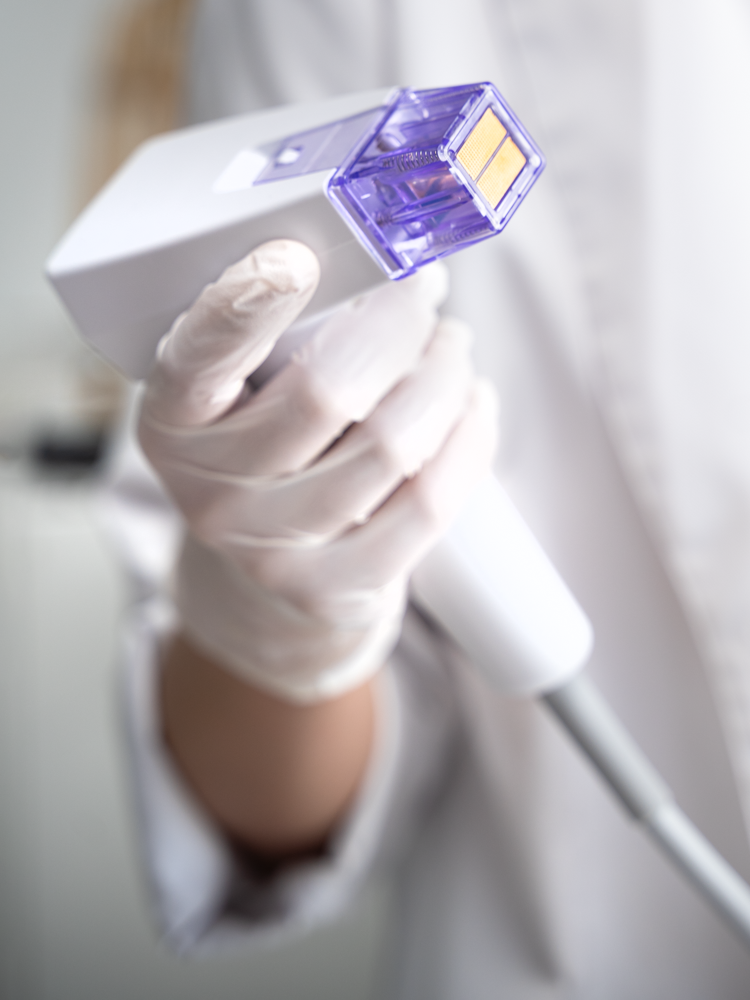 Radiofrequenz Behandlung im Gesicht Microneedling