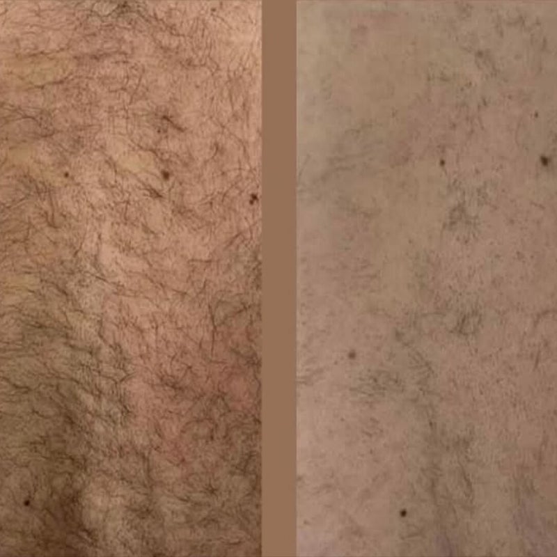 laserontharing mannen