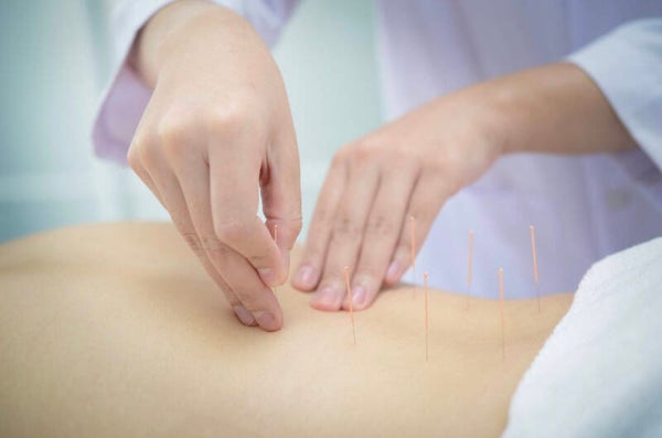 Acupuncture
