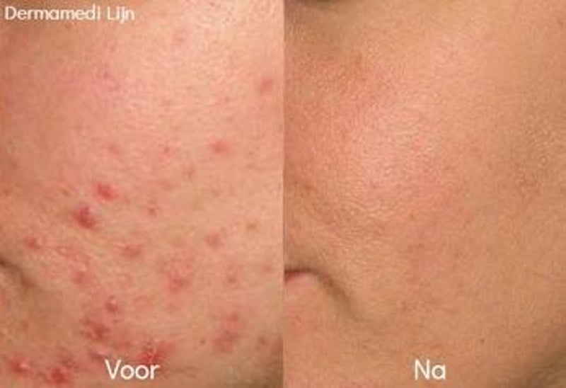 Acne voor en na foto