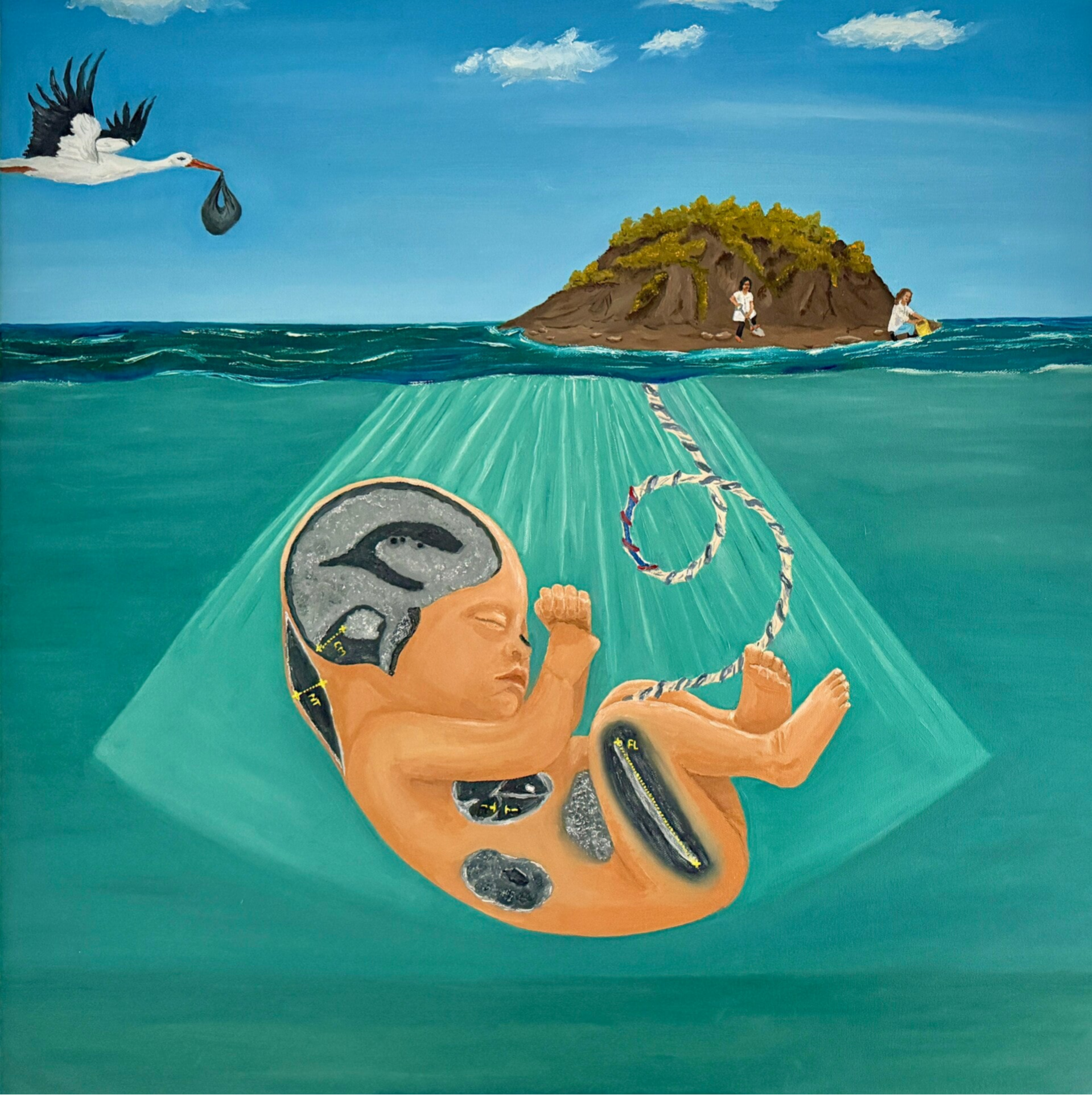 Schilderij prenatale soft markers