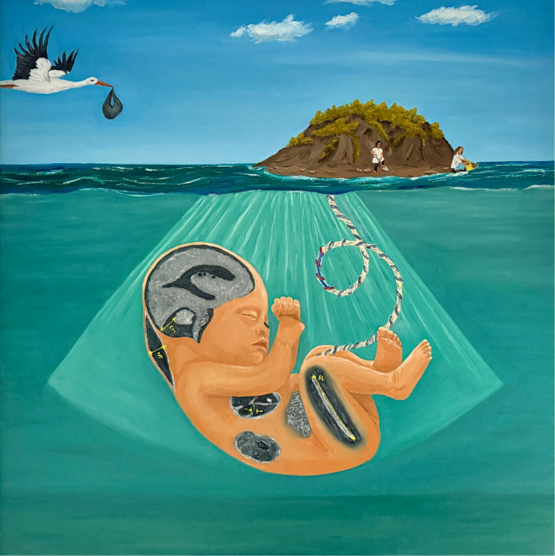 Soft markers on prenatal ultrasound | Softmarkers bij prenataal echo-onderzoek