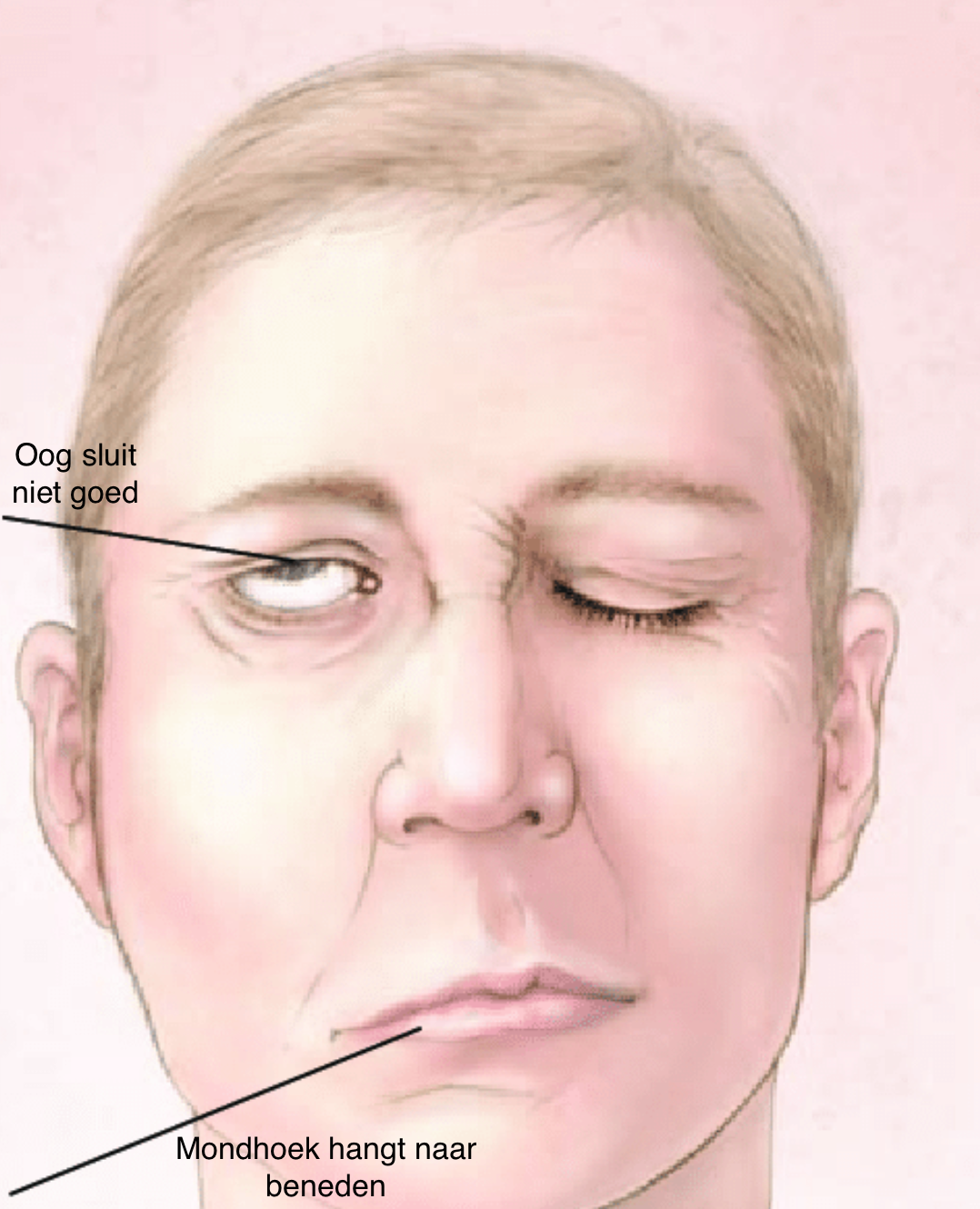 Aangezichtsverlamming neurologenalrijne Aangezichtsverlamming neurologenalrijne