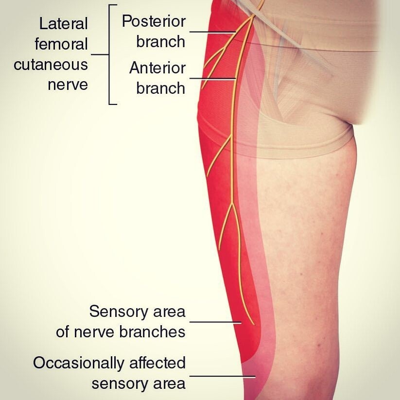 Meralgia Paresthetica Ziekte Info Neurologen alrijne Meralgia Paresthetica Ziekte Info Neurologen alrijne