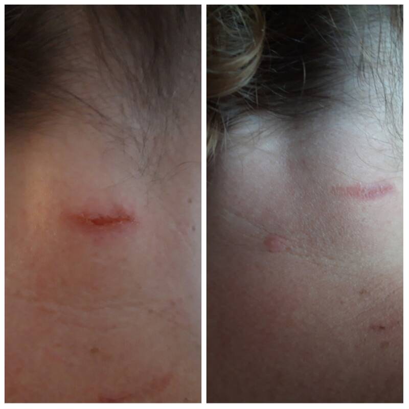 optisan pro biofotonen therapie snelle wondgenezing