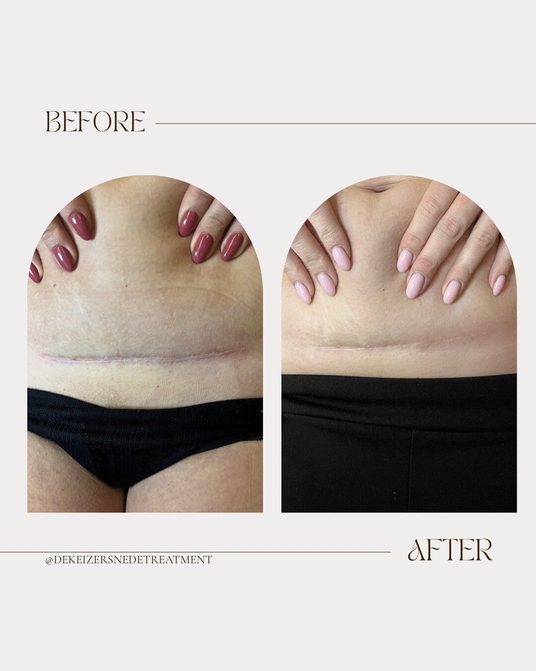 minimalist-transformation-before-after-instagram-story-2-standard-0hfsnv.jpg