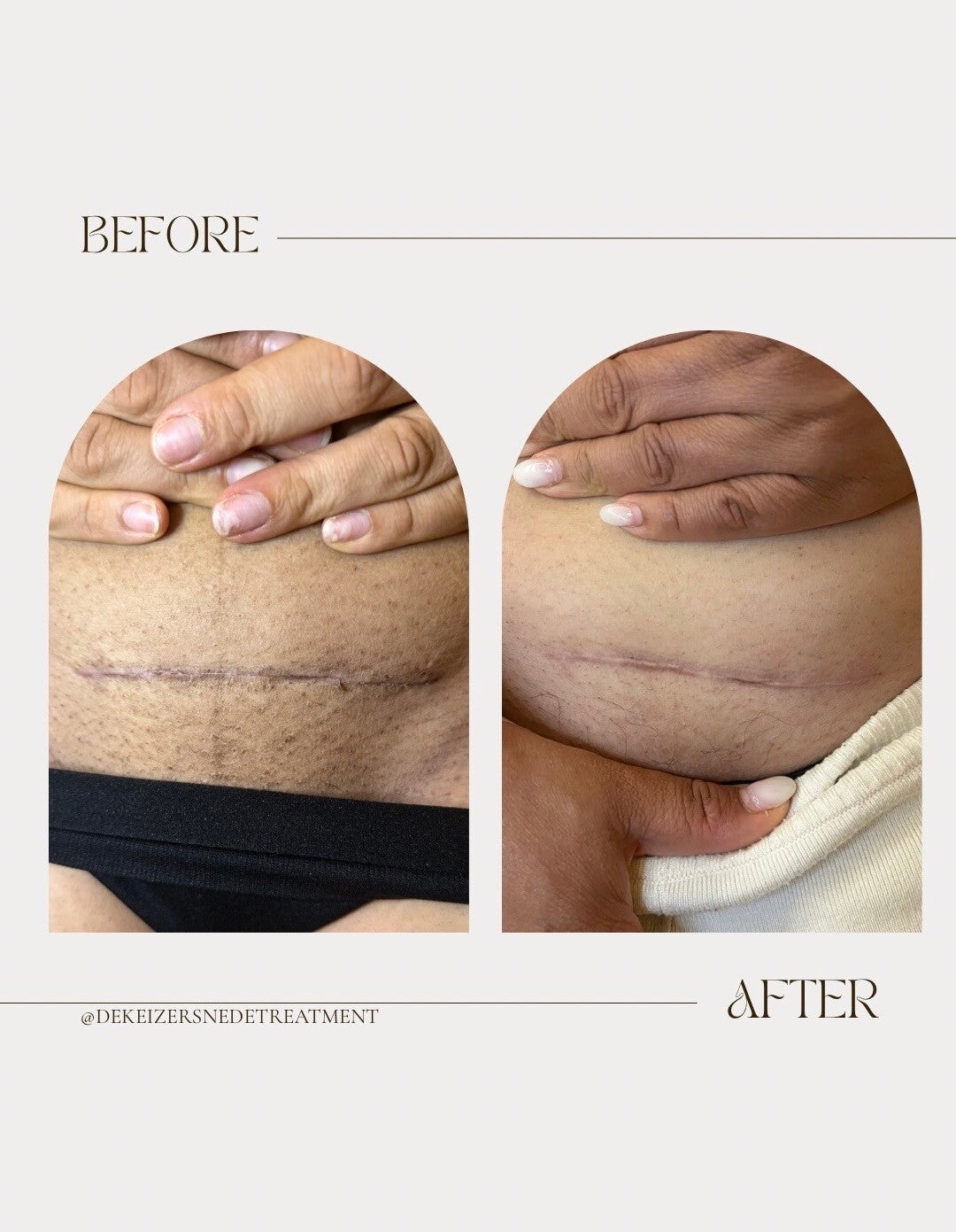 minimalist-transformation-before-after-instagram-story-2-standard.jpg