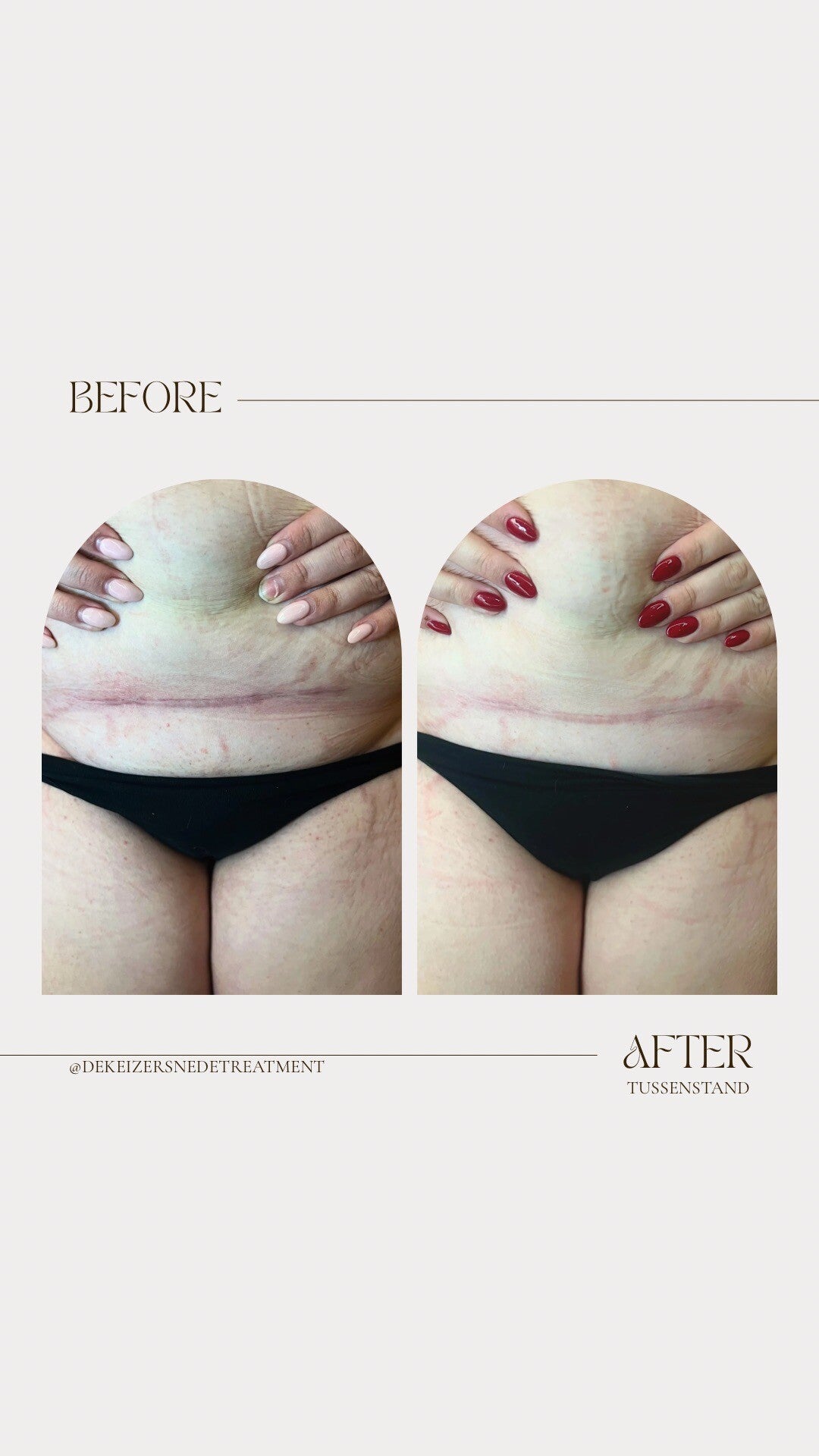 minimalist-transformation-before-after-instagram-story-3-standard.jpg
