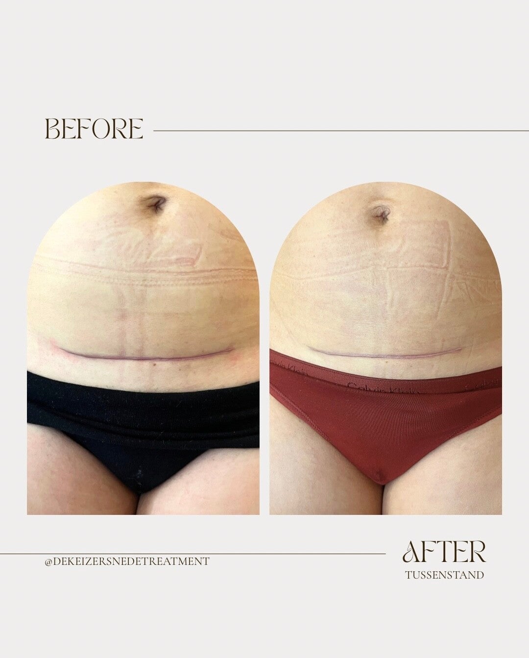 minimalist-transformation-before-after-instagram-story-6-standard.jpg