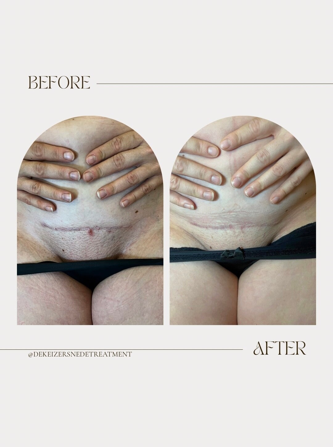 minimalist-transformation-before-after-instagram-story-standard-noccqx.jpg