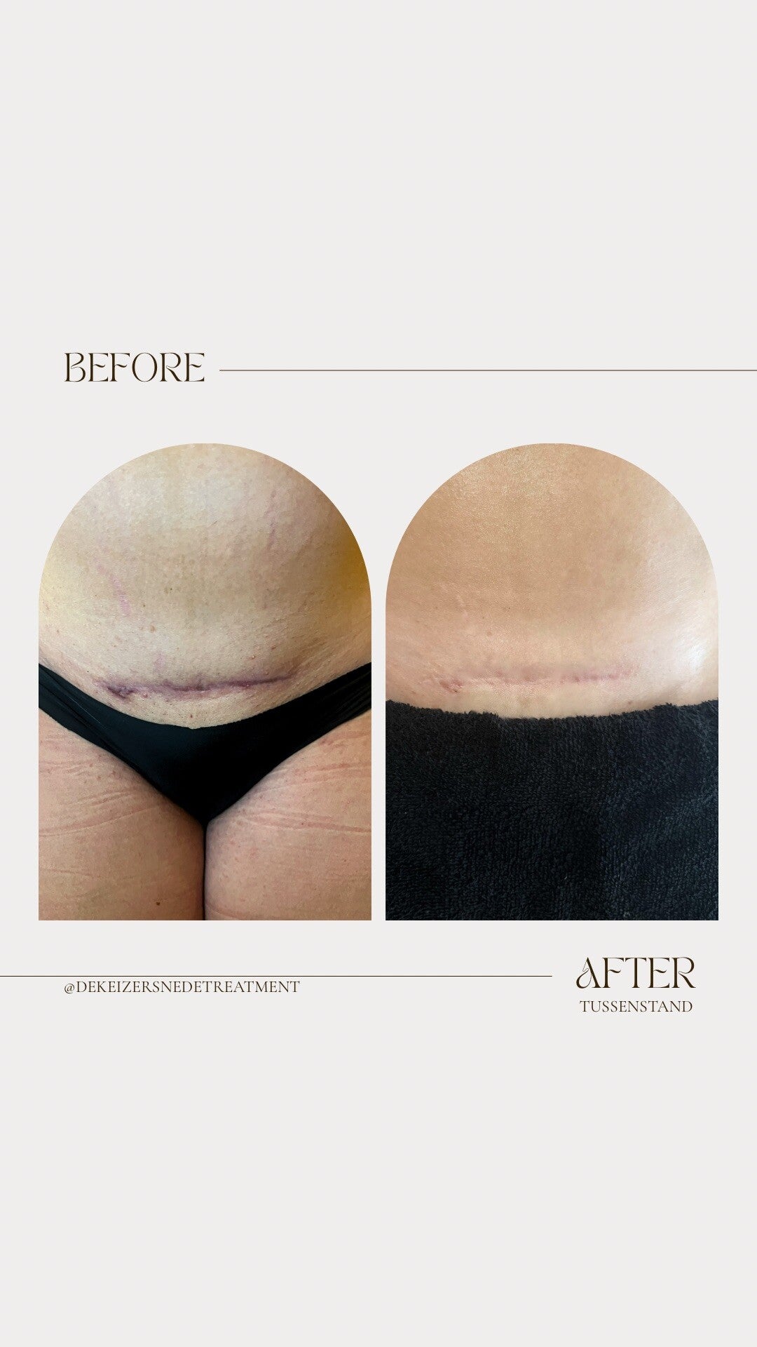 minimalist-transformation-before-after-instagram-story-standard-r95437.jpg