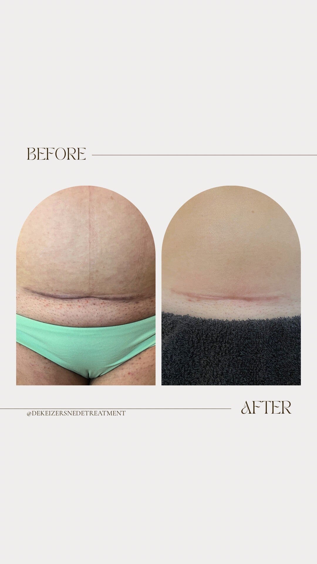 minimalist-transformation-before-after-instagram-story-standard-03020l.jpg