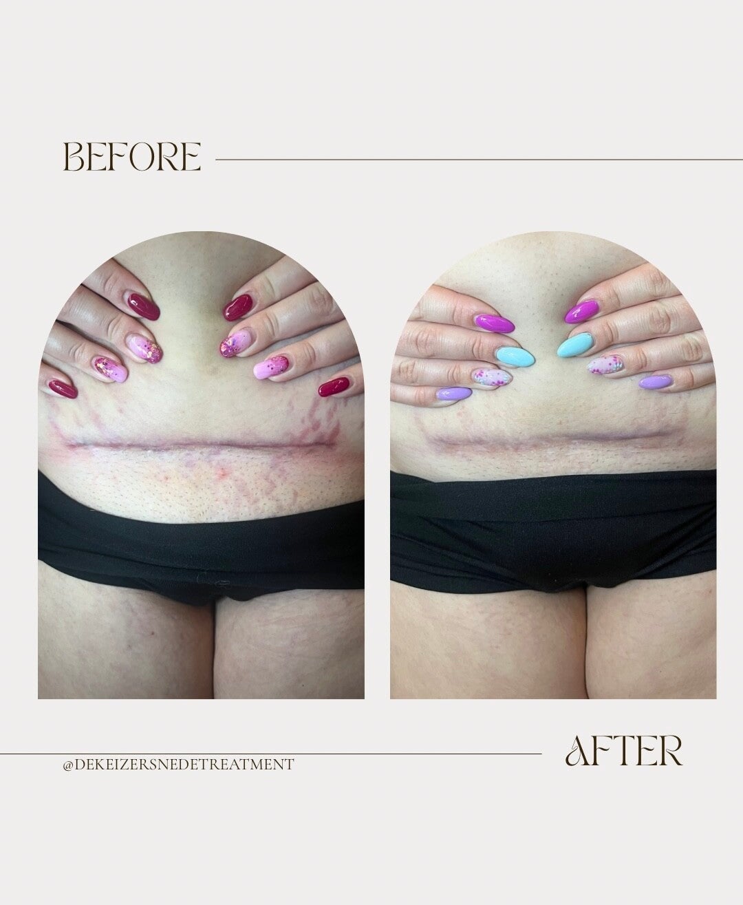 minimalist-transformation-before-after-instagram-story-standard-vxg20n.jpg
