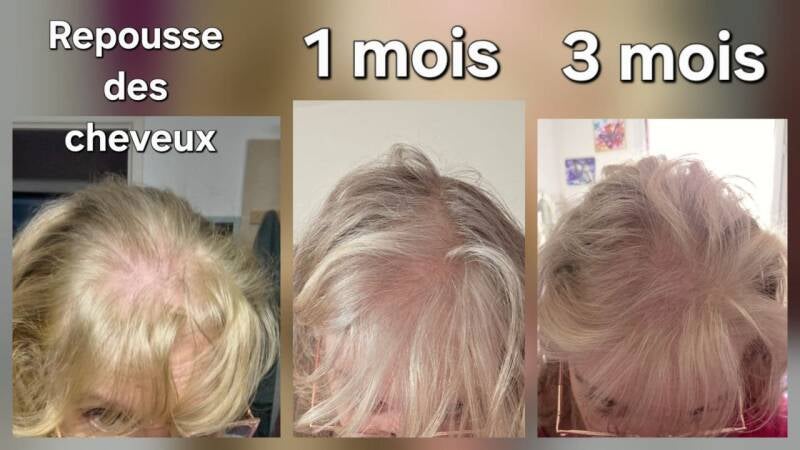 Évolution de la repousse des cheveux après 1 mois et 3 mois avec une routine ciblée associée au collagène et au soutien nutritionnel.