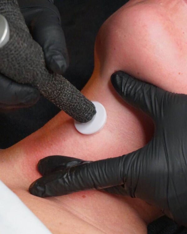 MICROCHANNELING COU et DÉCOLTÉ