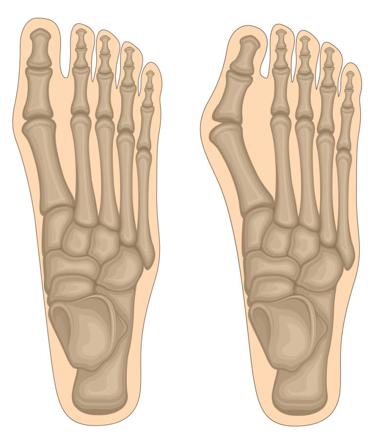 Wat is een hallux valgus? De mogelijke oorzaken en de oplossingen.