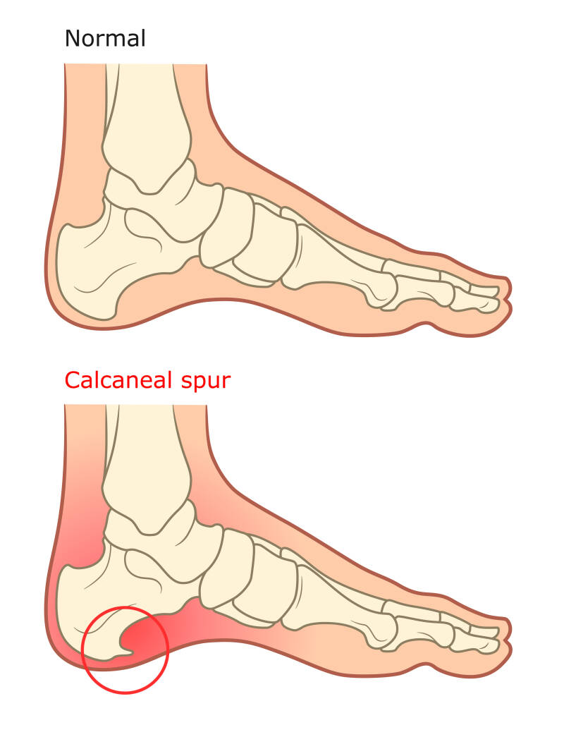 hielspoor of fasciitis plantaris? Watis het verschil?