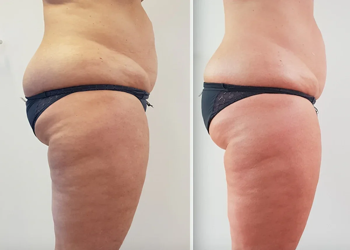 resultat_active_wrap_01-standard.webp