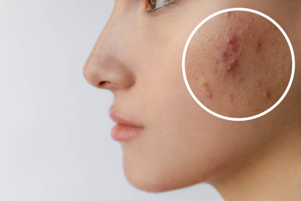 Soins pour les peaux à problèmes