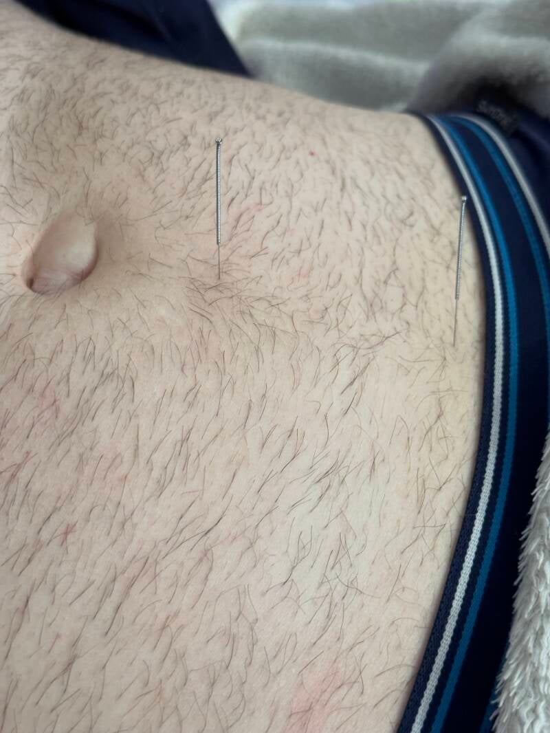 Exemple d'acupuncture