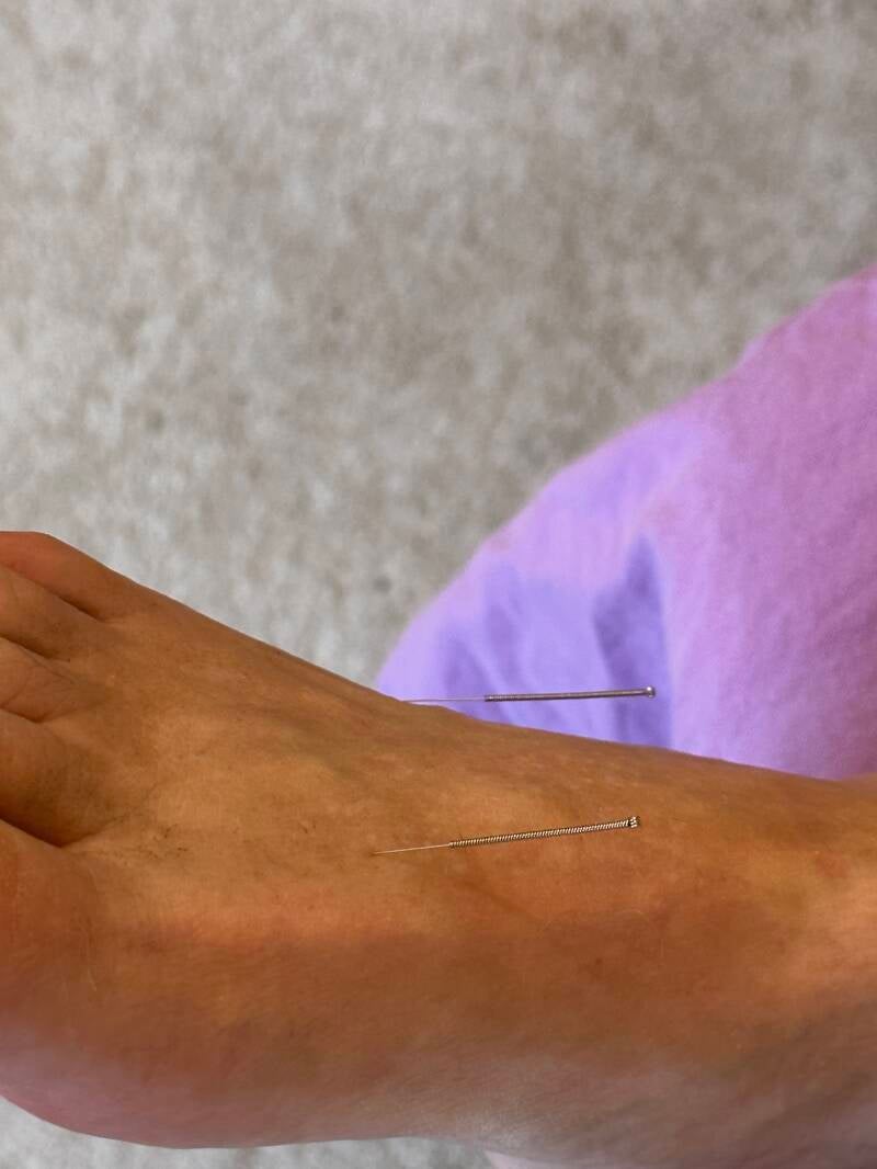 Exemple d'acupuncture