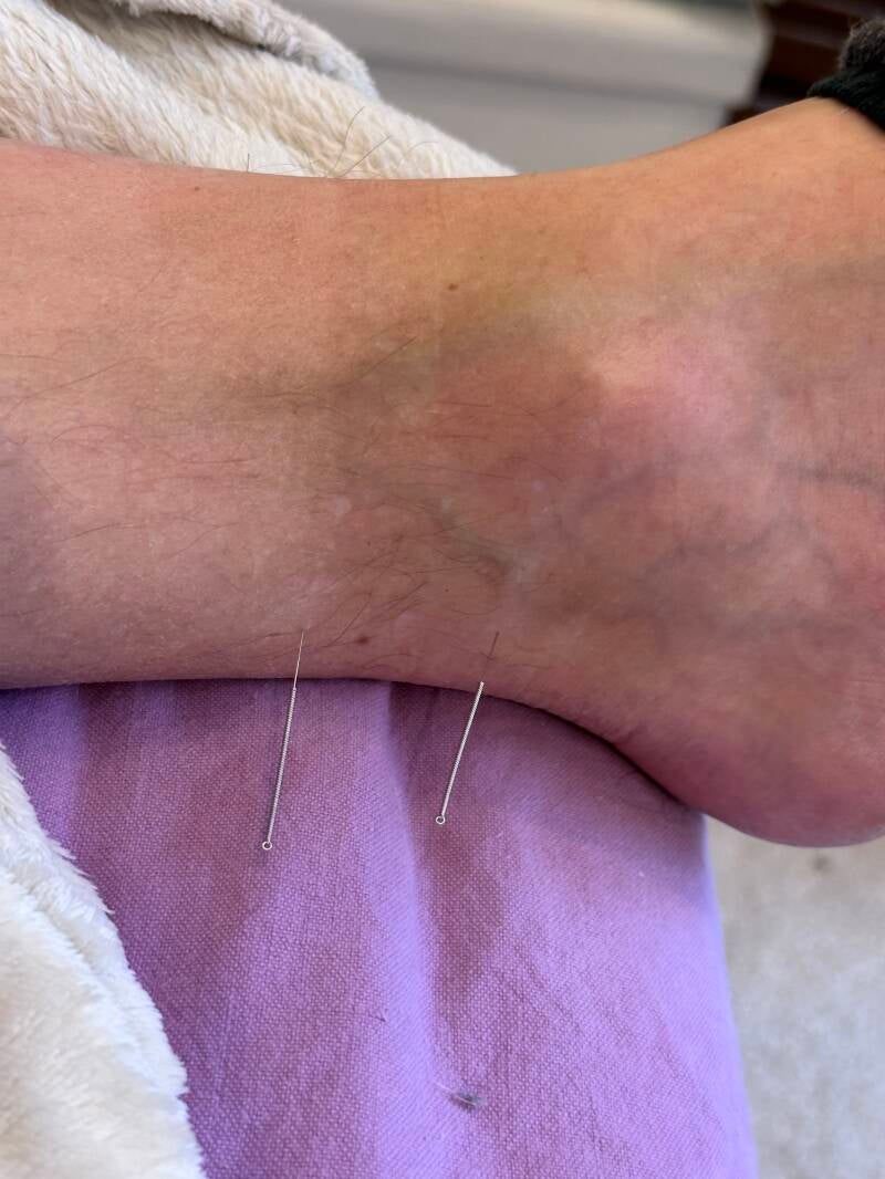 Exemple d'acupuncture