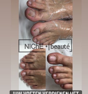 Voetverzorging van a tot z. Ingegroeide nagels behandelen zonder snijden.