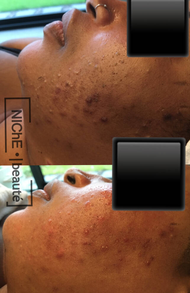 Effectieve Acnebehandelingen bij NIChE beauté Genk - Ontdek Jouw Weg naar een Stralende Huid! Ben je op zoek naar een betrouwbare oplossing voor acne? Bij [Naam van jouw Schoonheidssalon] bieden we professionele en effectieve acnebehandelingen die zijn af