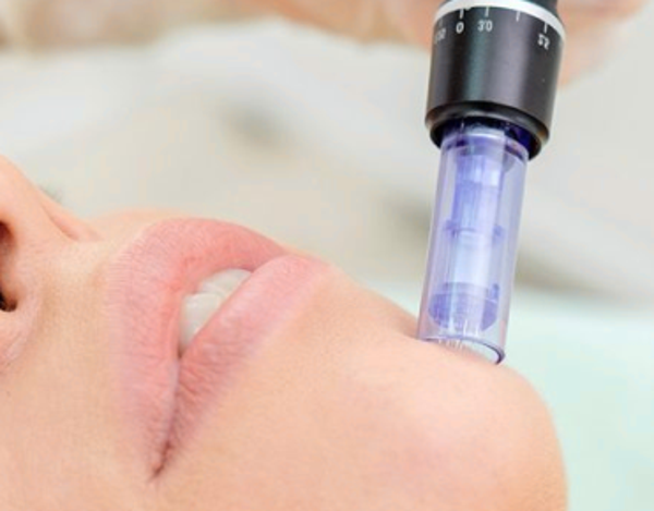 TRATAMIENTO DERMAPEN CON VITAMINAS