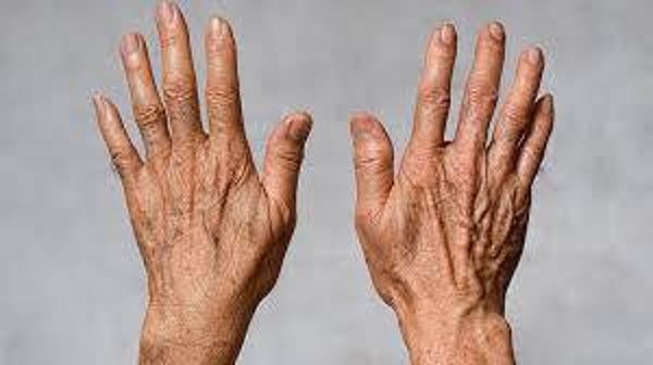 REJUVENECIMIENTO DE MANOS