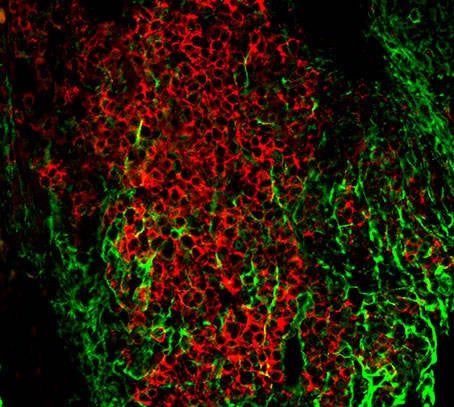 Myeloma cells (red) embedded in collagen fibers (green) within the bone marrow