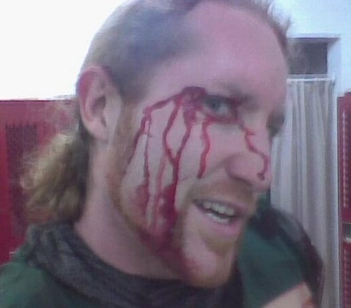 Joshua Knowles with a jousting injury