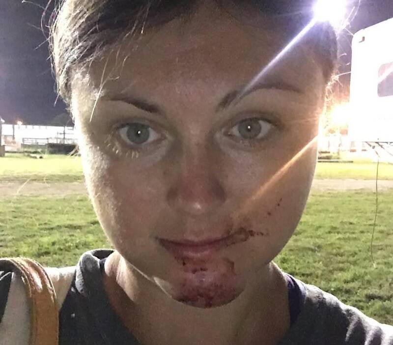 Jaclyn Ziemniak with a jousting injury