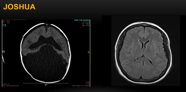 Two MRI scans of a brain labeled "JOSHUA," dated 09-16-2004, showing sagittal views with detailed brain structures, one with a dark mass and the other with clear cerebral cortex and spinal cord.