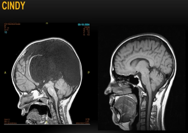 Two MRI scans of a brain labeled "CINDY," dated 09-16-2004, showing sagittal views with detailed brain structures, one with a dark mass and the other with clear cerebral cortex and spinal cord.