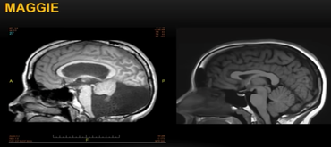 Two MRI scans of a brain labeled "MAGGIE" dated 09-16-2004, showing sagittal views with detailed brain structures, one with a dark mass and the other with clear cerebral cortex and spinal cord.