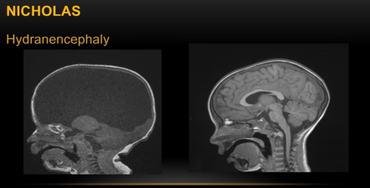 Two MRI scans of a brain labeled "NICHOLAS" dated 09-16-2004, showing sagittal views with detailed brain structures, one with a dark mass and the other with clear cerebral cortex and spinal cord.