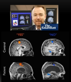 A Guardian article image featuring a man with brain scans, comparing "YES" and "NO" control and patient MRI scans with highlighted brain regions.