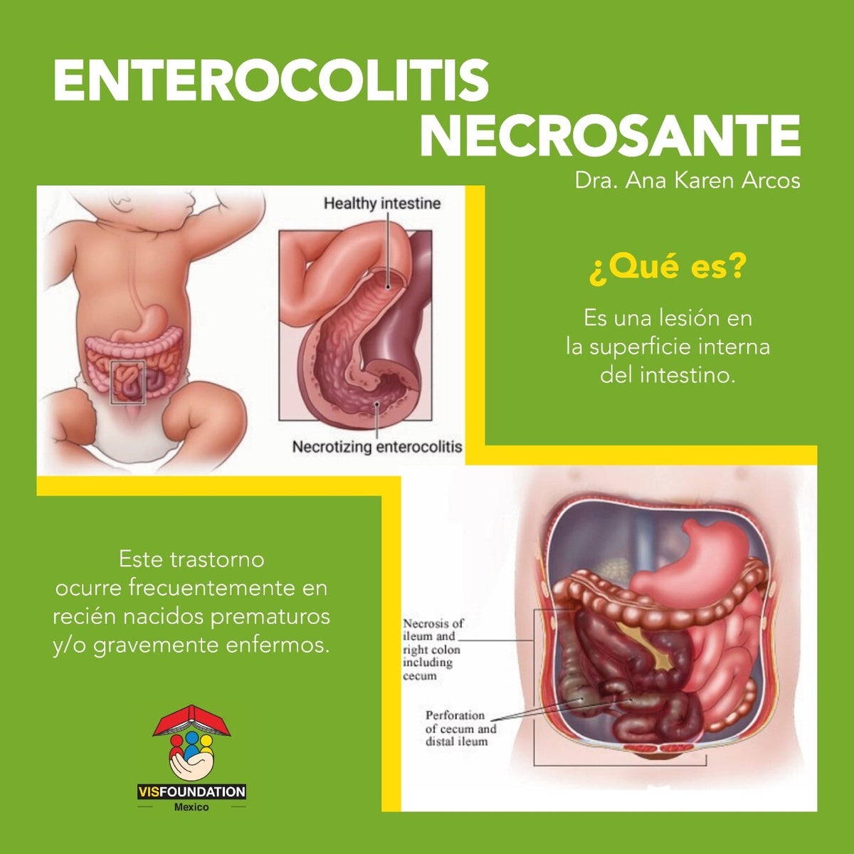 Enterocolitis Necrosante / Trastornos Del Recién Nacido | Cuidados del ...