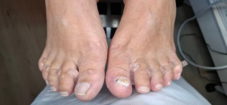 Voor behandeling met gel