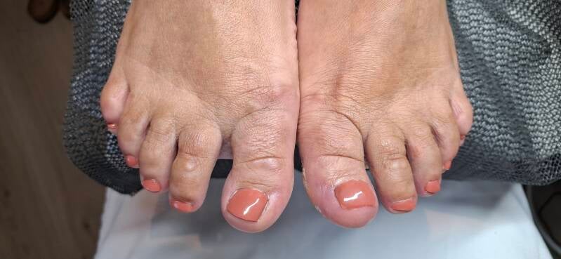 Na behandeling met gel